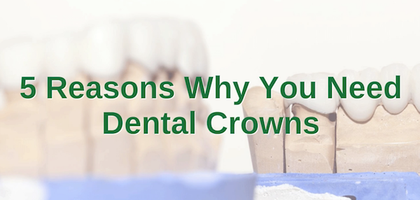 5 Reasons Why You Need Dental Crowns