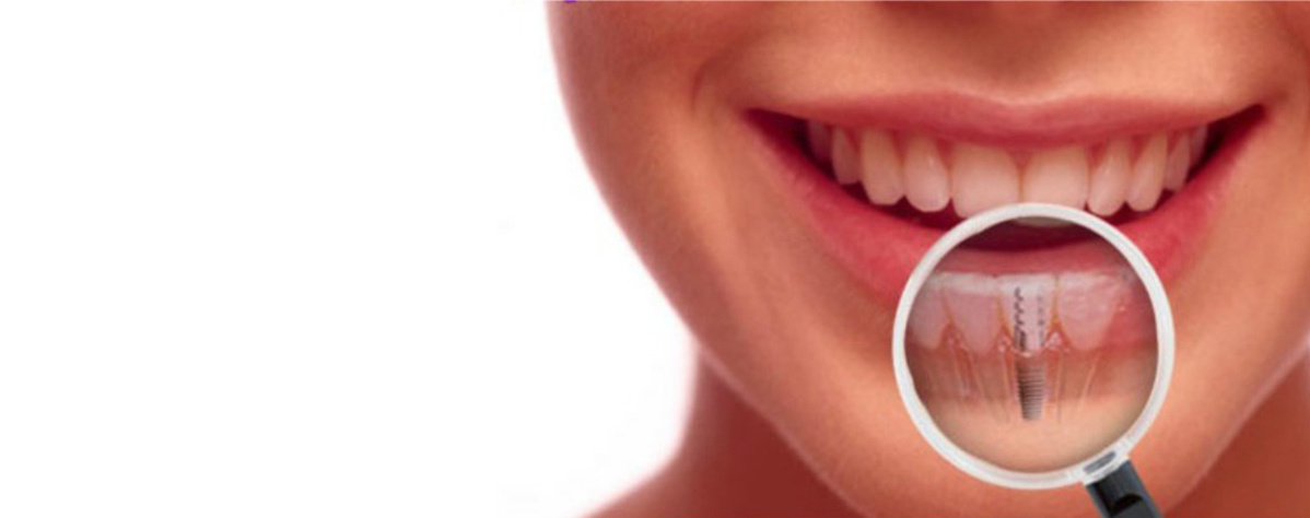 Are Dental Implants Right for You?