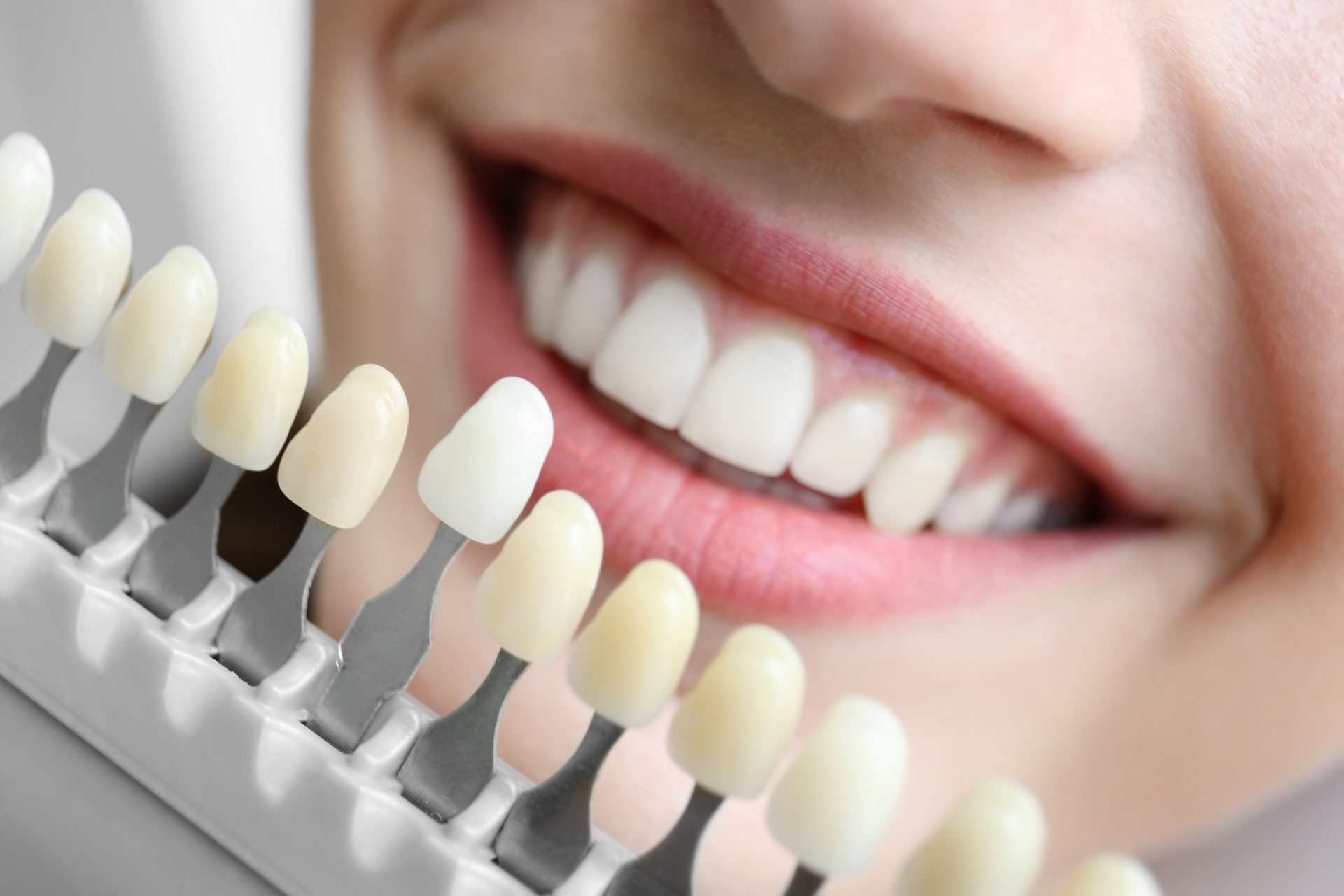 Affordable Modern Dental Implants in Glenroy