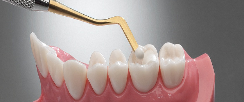 Glenroy Dental Guide – How Long Can You Expect A Dental Filling To Last?