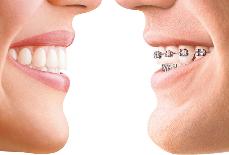 Dentist Glenroy Dental Guide : Top 3 Most Popular Braces Options For Adults