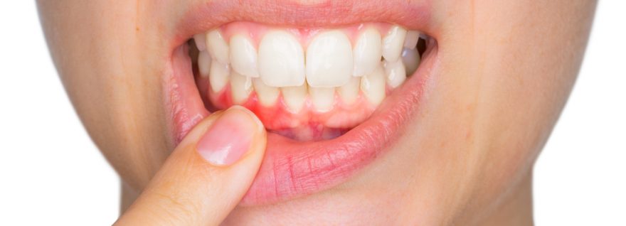 Dentist Glenroy Guide: Gum Disease – The “Cure” Is Treatment, Then Prevention