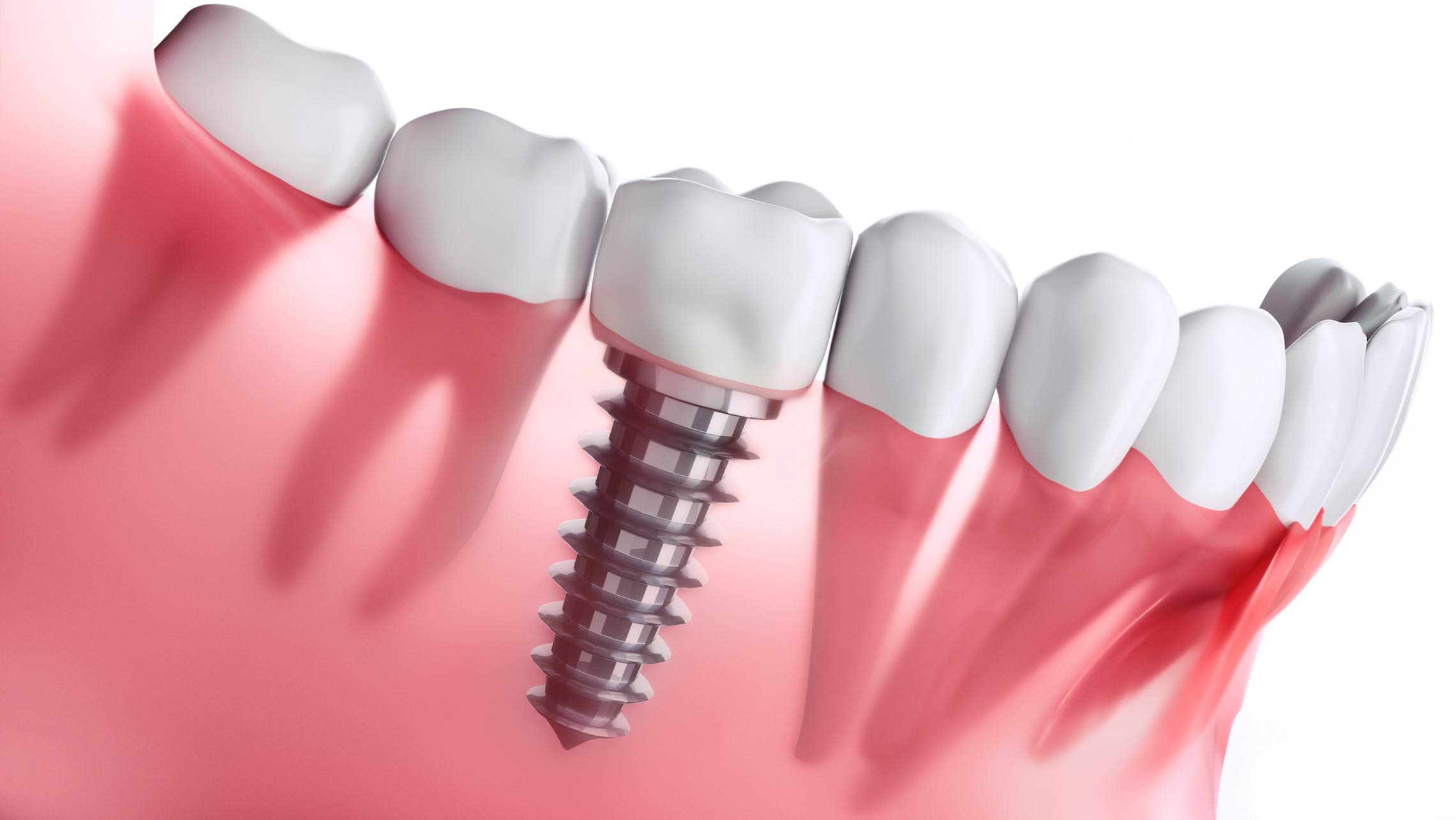 How Much do Dental Implants Cost in Glenroy?