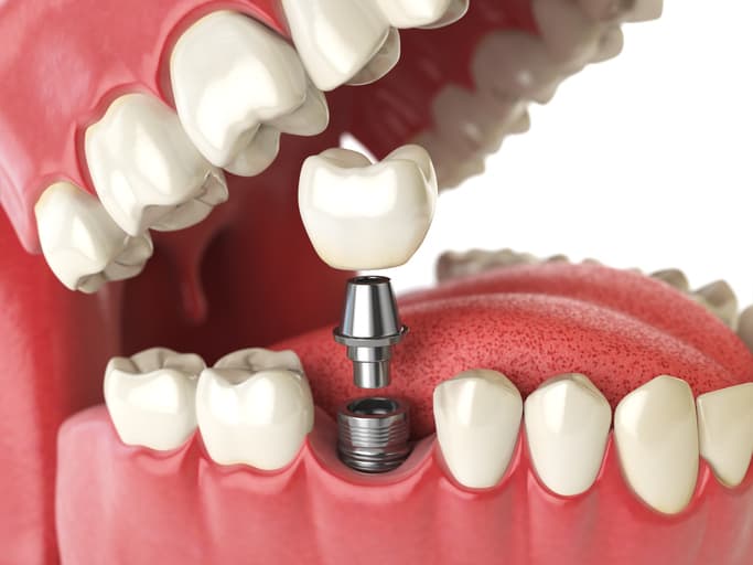 Where can I get Affordable Titanium/Zirconium Dental Implants in Glenroy