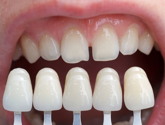 Where can I get quality dental veneers in Hadfield and Glenroy?