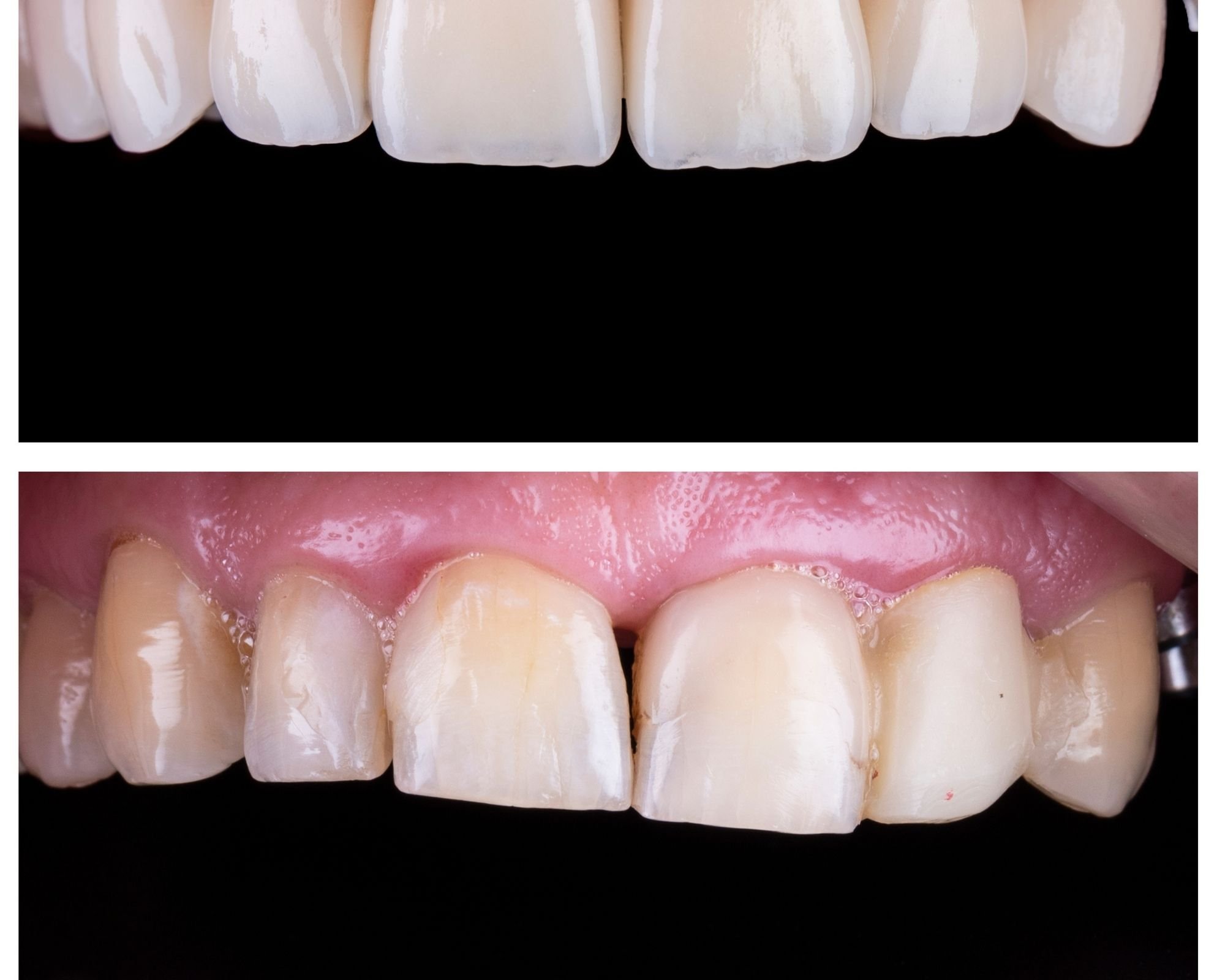 5 Great Tips to Look After Your Porcelain Veneers to Keep it Clean!