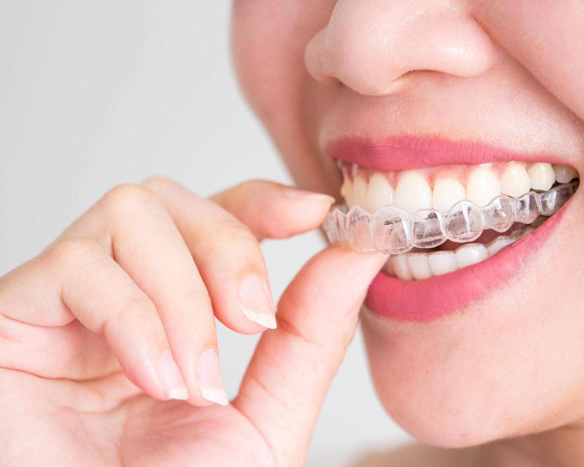 Invisalign VS Braces- Which One Is Better and Why?