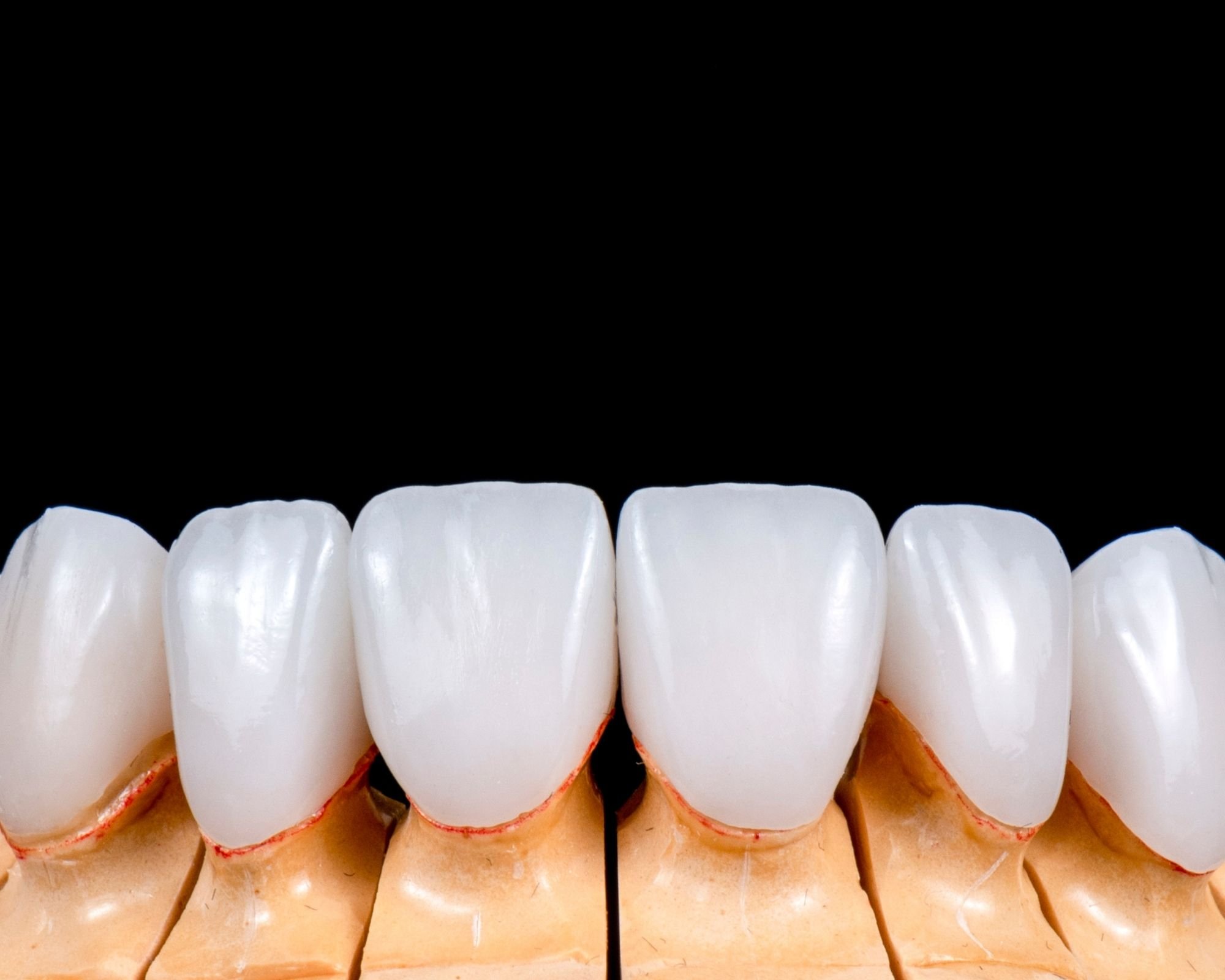 Veneers Vs Crowns- Which One Is Better For You?